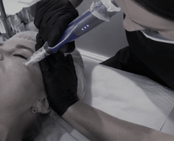 skinpen_2