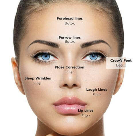 Botox_diagram Botox_diagram