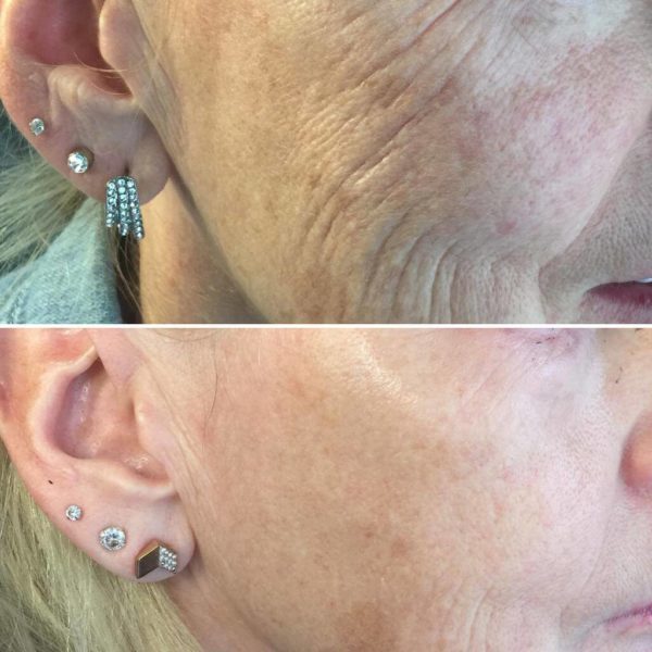 Plasma_skin_treatment_beforeandafter2 Plasma_skin_treatment_beforeandafter2
