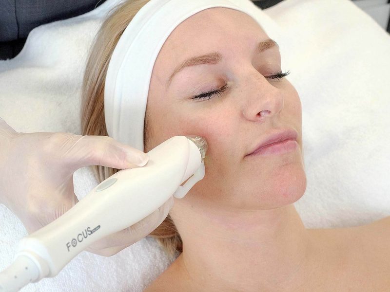 800x600-Focus-Dual-RF-Microneedling-Treatment-on-Ladies-Cheek