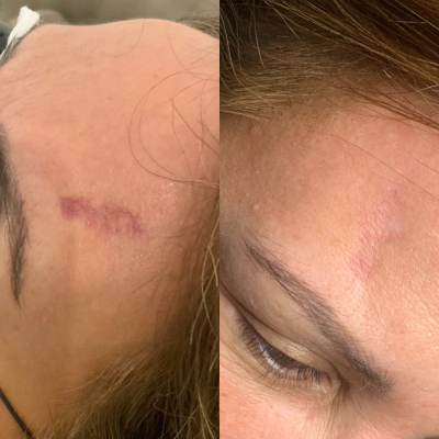 vascular IPL before & after